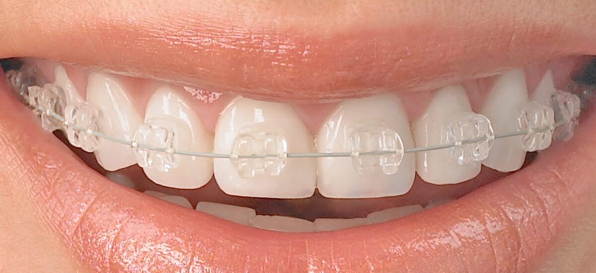https://clinicacantor.com/wp-content/uploads/2022/06/clinica-ortodoncia-jaen-dr-rafael-gallardo-tratamientos-ortodoncia-1200x550-1.jpg